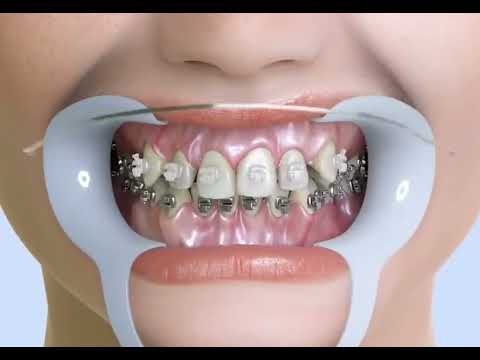 How Braces Work